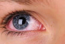 آنکھوں کا لال ہونا بھی کورونا کی علامت ہے