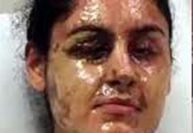 تیزاب گردی کا واقعہ، ملزم کی اطلاع کی انعامی رقم 40ہزار ڈالر کر دی گئی