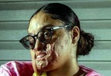 تیزاب گردی کا شکار ہونیوالی پاکستانی نژاد طالبہ نافیہ اکرام اب بھی کرب میں مبتلا